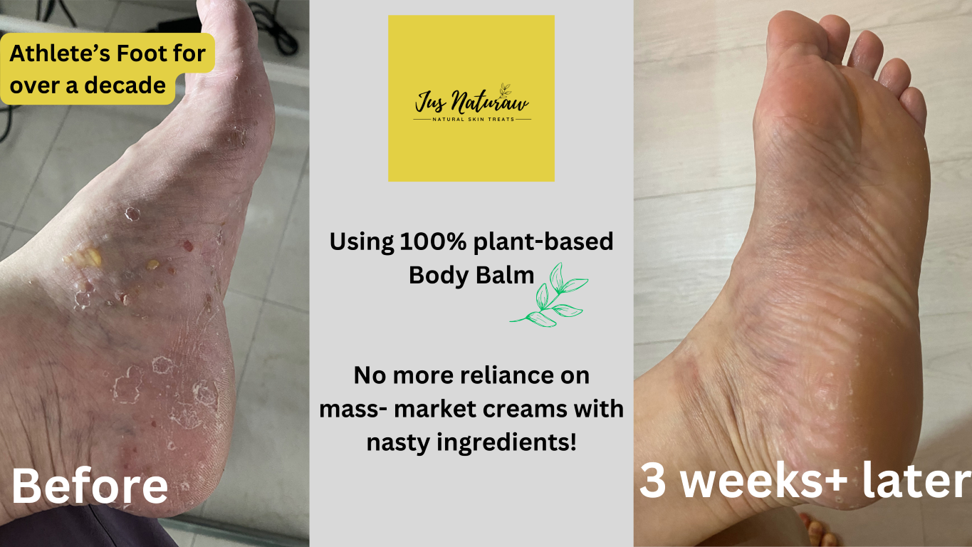 Load video: How i solve my athlete&#39;s foot issue using 100% plant-based body balm